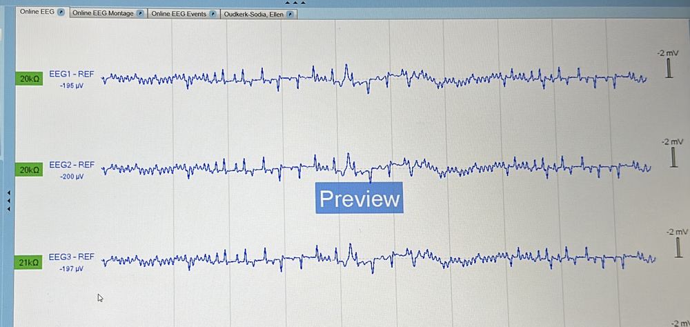 Live EEG trace recorded from forehead electrodes in the lab